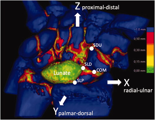 Figure 1. Bone volume registration technique analysis. The lunate is the fixed segment with green and yellow areas indicating no motion. Translation and total rotation in space of the scaphoid relative the lunate are measured in four points (COM: center of mass; SLP: scapholunate proximal; SLD: scapholunate distal; SDU: scapholunate distal-ulnar). The XYZ coordinate system is used to show translation and rotation axis orientation.