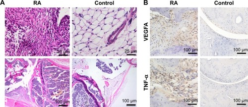 Figure 6 Histological analysis. (A) H…E staining shows hyperplastic synovium in inflamed joint and non-hyperplastic synovium in normal joint, which matched the results of NIR fluorescence imaging, further confirming the high specificity of imaging modes. (B) The immunohistochemical staining indicated the overexpression of VEGFA and TNF-α in inflamed joint, which showed that imaging by using iLPs as probes can reflect the severity of RA, to some extent.Abbreviations: RA, rheumatoid arthritis; NIR, near-infrared.