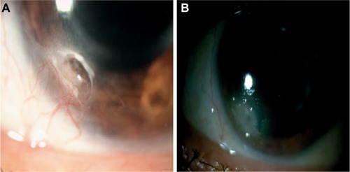 Figure 5 Photographs (patient # 5) with deep corneal ulcer, associated neovessels and risk of corneal perforation.
