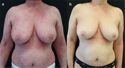 Figure 3. Representative images of outcome in the breast/abdomen region in Patient #2. A female patient aged 56 years with onset of psoriasis at 50 years of age treated for erythrodermic psoriasis. After presenting with diffuse erythroderma (A), that was treated with systemic steroids and brodalumab at scheduled dosage, she experienced a rapid improvement, reaching clinical remission in 3 months (B)