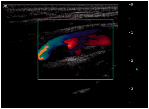 Figure 2. Carotid artery with stenosis and mosaic pattern on colour Doppler.