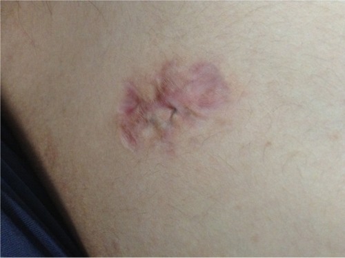 Figure 2 The photo shows atrophic scar on the shoulder.