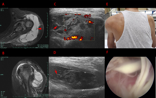 Figure 3 Disease record during recurrence. (A and B): T2-weighted image shows a lot of fluid accumulation in the subacromial-subdeltoid region with necrotic synovial tissue floating. (C and D): Ultrasound examination showed some synovium looked like ‘floating weeds’. (E) Apparent joint swelling of the patient. (F): The necrotic synovium floating in the joint cavity and not completely detached under arthroscopy.