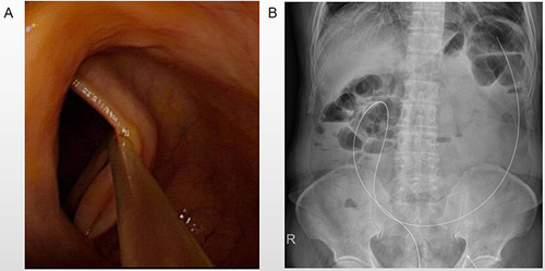 Figure 2 Colonoscopy administration. Bacterial fluid injection tube (A) and its positioning imaging (B).