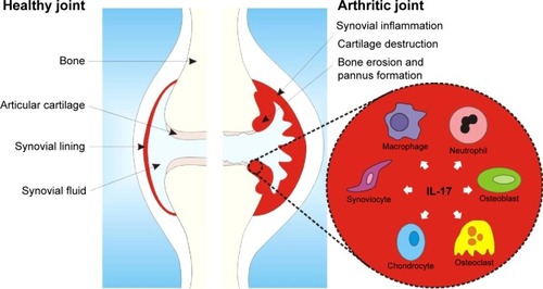 Figure 2 Simplified scheme of IL-17 and its effector cells in the inflamed arthritic joint.