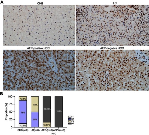 Figure 5 Immunohistochemical staining for ANGPTL2 in liver tissues from patients with CHB, LC and HCC.Notes: (A) The staining of ANGPTL2 immunohistochemistry in liver tissues (original magnification ×200). (B) The scores of hepatic ANGPTL2 staining were demonstrated as histogram. The immunoreactivity of ANGPTL2 was graded according to the average percentage of ANGPTL2-positive cells in each tissue sample as follows: <25% (1), 25–50% (2), >50–75% (3) and >75% (4).Abbreviations: ANGPTL2, angiopoietin-like protein 2; CHB, chronic hepatitis B; LC, liver cirrhosis; HCC, hepatocellular carcinoma; AFP, alpha-fetoprotein.