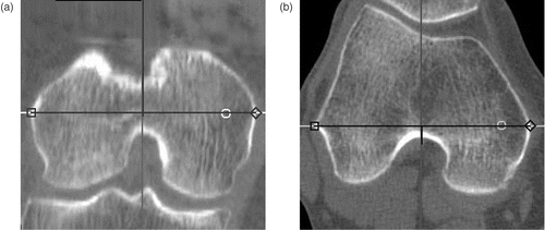 Figure 2. The transepicondylar axis was determined by connecting the most prominent points of both the medial and lateral epicondyles in both the coronal plane (a) and the axial plane (b).
