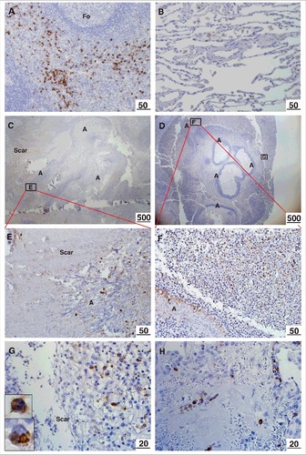 Figure 1. Immunohistochemical localization of M-ficolin to the aspergilloma. Brown staining indicates presence of M-ficolin. (A) Control immunostaining of monocytes/granulocytes in the spleen. (B) Control alveolar tissue. Overview of elongated A. fumigatus fungal balls surrounded by pulmonary scar tissue in patient 1 (C) and patient 2 (D). The boxes indicate the location of images E-G. (E) Pulmonary scar tissue and A. fumigatus mycelial zone. (F-G) Peripheral zone of aspergilloma (Upper insert: granulocyte. Lower insert: monocyte). (H) Pulmonary blood vessels in scar tissue from a lung with A. fumigatus infection. Fo = follicle. A = A. fumigatus. Scar = scar tissue. The lengths of the bars are in micrometers