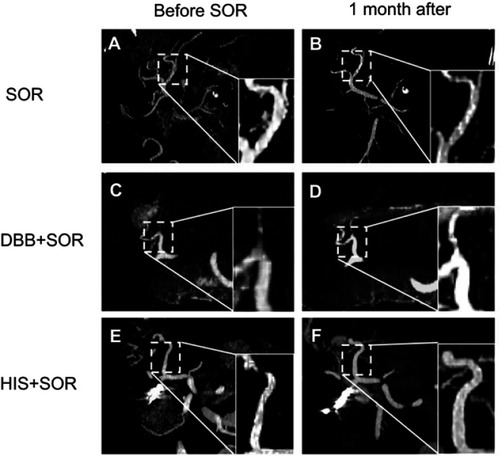 Figure 3 Representative 3D images of vasculature in the SOR, DBB+SOR, and HIS+SOR groups. 3D images of the LHA in the SOR monotherapy group before SOR administration (A) and approximately 1 month after initiation of SOR (B). DBB+SOR group (C and D). HIS+SOR group (E and F).Abbreviations: LHA, left hepatic artery; SOR, sorafenib; DBB, dried bonito broth; HIS, histidine.