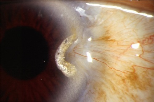 Figure 2 Untreated pterygium recurrence 3 years following successful surgery.