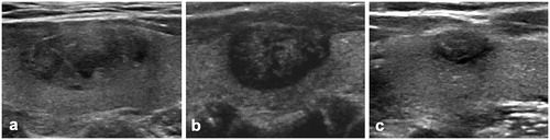 Figure 1. US image of a 48-year-old female with a benign thyroid nodule. (a) Before RFA, US image showed a solid benign thyroid nodule located in the left thyroid lobe with an initial volume of 1.78 ml. (b) At 1 month after RFA, the volume of nodule was 0.98 ml and the VRR was 44.65%. (c) At 36 months after RFA, nodule shrunk to 0.21 ml and the VRR was 88.05%.