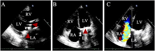 Figure 2. Echocardiography manifestations [A-B: the aortic and mitral mechanical valves (red arrows) were well placed with good activity of the valve leaflets and normal perivalvular surroundings with iso-echogenicity attached. C: There was no significant thickening of the tricuspid valve leaflet. Further, the valve showed good opening but poor closing].