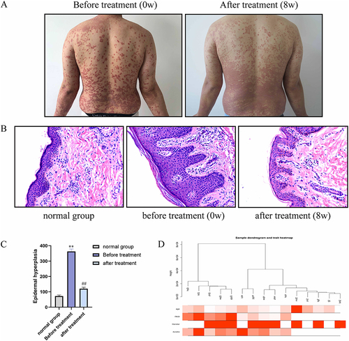 Figure 1 Images of clinical samples. (A) Images of psoriasis lesions before and after treatment. (B) H&E staining of tissues from patients and normal group. Scale bar = 50 µm. (C) Images of H&E-stained sections showing epidermal hyperplasia. (D) Cluster tree and heat map of samples according to the expression data of 15 samples. This is a cluster analysis of the 15 samples we have obtained. The average expression level of genes was analyzed using WGCNA. *vs normal group, **p < 0.01, #vs before treatment, ##p < 0.01.