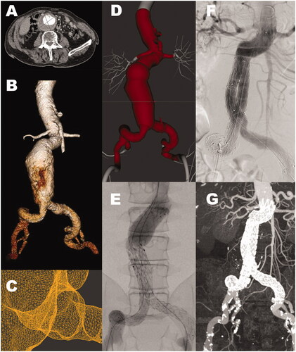 Figure 3. Patient with aneurysmal dilatation of the abdominal aorta, male, age 86 (A) Computed tomography angiography shows an aneurysm with a maximal diameter of 71 mm. (B) Segmented surface-rendered 3D reconstruction. (C) Detail from the STL model of the ostium of the artery to the left kidney. (D) The imported STL model (center) in the simulator stitched to the simulator template (light gray). (E) Angiogram of the stent-graft components on the simulator. (F) Angiogram of the stent-graft components in the patient. Visually E and F show poor correlation. (G) CT-angiogram at six months follow-up.
