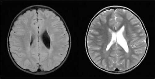 Figure 4 Case 1 - FLAIR ax, T2 ax.