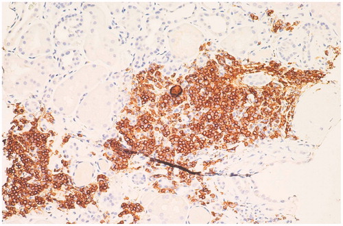 Figure 2. Immunohistochemistry for CD20: interstitial lymphoid infiltrates of B lymphocytes (200×).