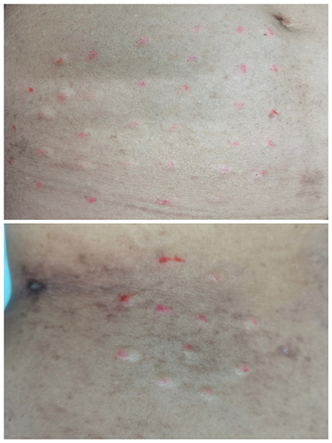 Figure 1 Patients were treated with intradermal injections of BoNT/A at the site of the affected pain areas. Injection sites were distributed in a checkerboard-like pattern, with a space of approximately 1.5–2 cm between two injection sites.