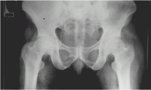 Figure 4. X-ray showing complete disappearance of calcification after successful renal transplantation.