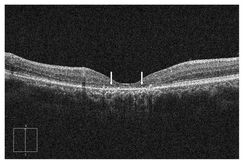 Figure 1 The optical coherence tomography of a patient with photoreceptor disruption demonstrated the discontinuity of the inner segment/outer segment line (arrows).