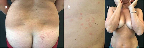 Figure 4. Representative images of outcome at the lower back and gluteal region in Patient #4. A female patient aged 41 years treated for chronic plaque psoriasis. After presenting with severe chronic plaque psoriasis that was treated with UVB phototherapy, methotrexate and a range of other biologics, she complained of generalized eczema with diffuse intense itching symptoms during treatment with ixekizumab (A). Subsequent failure of treatment with guselkumab resulted in fine scaling and diffuse psoriatic lesions, mainly localized on the back and legs (B) that was subsequently treated with brodalumab at scheduled dosage where she experienced a rapid improvement, achieving clinical remission in 4 months (C)