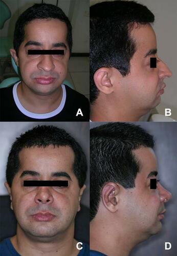 Figure 11 Frontal and lateral aspects of the patient before (A and B) and after (C and D) the rehabilitation procedure.