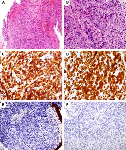 Figure 2 H&E and IHC staining in the urinary bladder sample of ALK-positive ALCL.