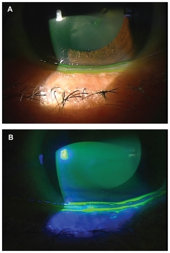 Figure 3 The patient presented with ocular irritation. (A) Preoperative photograph showing CCh on the edge of the lower eyelid. The patient also had keratoconjunctivitis sicca. (B) A preoperative photograph showing fluorescein staining. The CCh divides the tear meniscus into two layers. Punctate conjunctivitis is seen on the CCh.