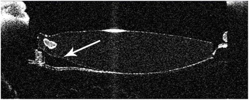 Figure 8 Anterior segment optical coherence tomography photo showing disrupted barrier effect of the ring (arrow) and opacification of the posterior capsule.