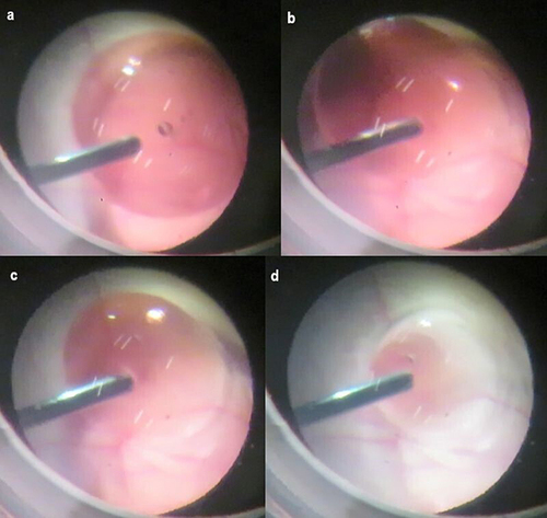Figure 5 Sucking out the SO layer in the pig eye using a fragmatome. (a) The tip of the fragmatome easily reached the immiscible droplet on the posterior retina. (b) Emulsifying the SO near the surface of the SO layer of the immiscible droplet. (c) Easy removal of the SO layer in the vitrectomized pig eye was enabled through the utilization of emulsification and high suction pressure by using a fragmatome. (d) Immediately after this photo, the SO layer in the vitrectomized pig eye was completely removed.