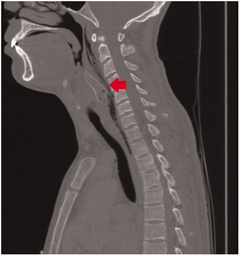 Figure 1. (Mid) sagittal section of CT-scan of the head and neck area revealing a foreign body (arrow) of ±5 cm in length and 1.5 cm across at the level of the hypopharynx and the proximal oesophagus.
