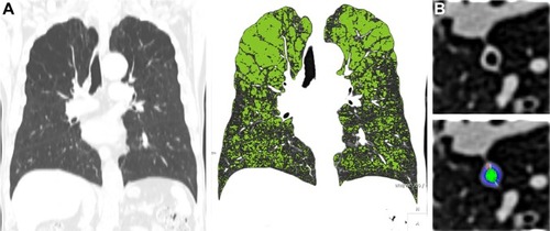 Figure 2 Quantitative CT analysis of emphysema and bronchial wall thickness.