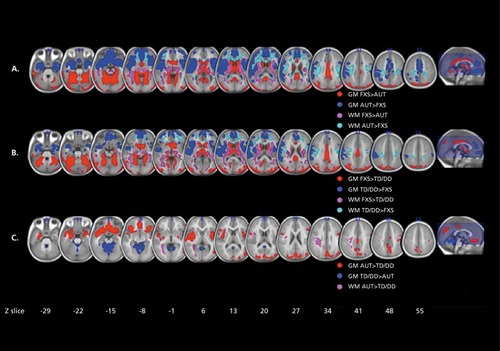 Figure 7. Differences in regional brain volume in fragile X. A: Regions showing significant differences in regional gray matter (GM) volume and white matter (WM) volume between fragile X syndrome (FXS) and idiopathic autism (iAUT) (panel A), FXS and typically developing (TD) and idiopathic developmentally delayed (DD) controls (panel B), and iAUT and TD/DD controls (panel C). The left side shows the right hemisphere. The statistical threshold is set at P=0.01 , familywise error cluster-level corrected. Montreal Neurological Institute coordinates. Adapted from ref 118: Hoeft F, Walter E, Lightbody A, et al. Neuroanatomies! differences in toddler boys with fragile X syndrome and idiopathic autism. Arch Gen Psychiatry. 2011;68:295-305. Copyright © American Medical Association 2011