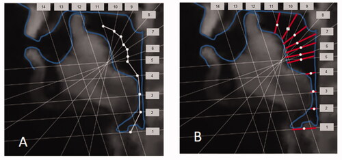 Figure 6. (A) Shows the system of gridlines used for deriving the vocal tract cross-distances needed to represent the shape of the vocal tract as a cross-sectional area function. Calibrated in real mm it is used to measure the width of the vocal tract along each gridline and to construct a vocal tract midline as a piecewise linear contour passing through the midpoints of the width segments (indicate by white dots and connecting lines). In (B) these width segments have been modified in length and rotated around their midpoints so as to be approximately normal to the midline. Their lengths, so modified, now define the cross-distances (i e between tongue and back pharynx wall/palate) needed to calculate cross-sectional areas using the linear distance-to-area rules.