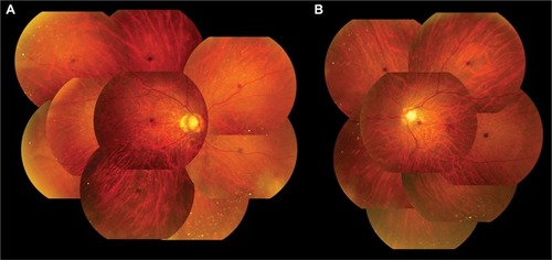 Figure 1 Color fundus photographs of the right (A) and left (B) eyes.