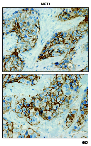 Figure 7. MCT1, a metabolic marker for the uptake of high-energy mitochondrial fuels, is predominantly localized to epithelial cancer cells, and absent from adjacent tumor stromal cells, in human breast cancers. Paraffin-embedded sections of human breast cancer tumor tissue were immunostained with antibodies directed against MCT1. Slides were then counter-stained with hematoxylin. Note that MCT1 immunostaining is largely absent from the stromal compartment and confined to the epithelial compartment (brown color). Original magnification is 60x, as indicated.