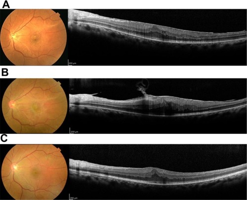 Figure 1 Spectral domain optical coherence tomography B-scan images at the initial visit (A), before surgery (B), and after surgery (C).