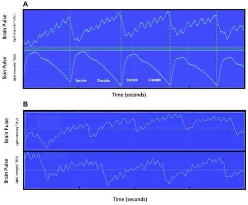 Figure 6 (A) Brain and skin oximeter simultaneous recording of PPG waveforms during hypoxia (inspired oxygen 15%), for subject 1. A high-frequency oscillation (~7 Hz) was present in brain PPG waveform, but not the skin PPG waveform. The dashed lines represent the start of each skin pulse. Oscillations at this frequency in physiological recordings have been demonstrated for intra-cranial pressure in humans and represent physical movement “ringing” of the brain in response to the systolic pressure wave entering the brain substrate. (B) Shows similar high-frequency oscillations in subjects 2 and 6.Abbreviation: AU, arbitrary units.