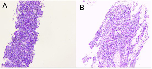 Figure 2 Pathological findings of liver mass in segment VII-VIII. Hematoxylin and eosin (H&E) staining. Original magnification: (A)×40. (B) ×100.