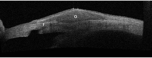 Figure 11. An ASOCT (Visante, Carl Zeiss Meditec) image image of a bleb with Ologen implant at 30 days. The Ologen implant (o) is visible over the scleral flap (f).
