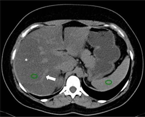 Figure 10 CT image of fatty liver disease.