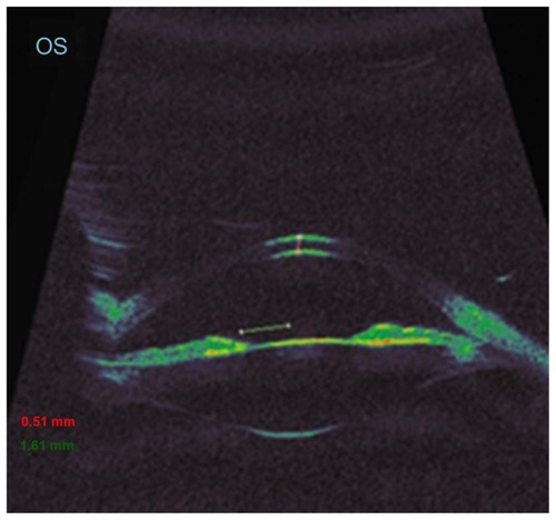Figure 1 Ultrasound biomicroscopy revealed a normal corneal thickness and a wide open iridocorneal angle.