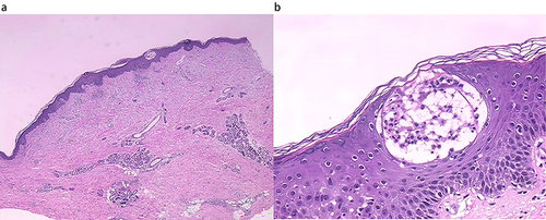 Figure 2 (a) (X low magnification) (b) (X high magnification). Pathology examination: Excessive keratinization, incomplete keratinization, and neutrophilic microabscesses within the stratum corneum; irregular hyperplasia of the epidermis, local spongiosis, thinning or absence of granular layer, neutrophilic pustules within the epidermis, dilated dermal papillary blood vessels, and infiltration of neutrophils and lymphocytes in the surrounding area.