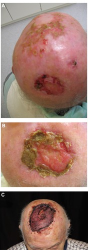 Figure 1 (A–C) Chronic eosinophilic dermatosis of the scalp in a 76 year-old male. (A) Overview. (B) Detail of crusted and erosive lesion with overgranulation. No signs of reepithelialization. (C) Excision and split-skin transplant. Ten days after transplantation, a stable transplant without recurrence is seen.