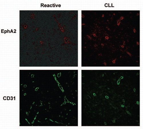Figure 1 EphA2 is differentially expressed in the CD31+ vascular vessels of human lymph nodes. 8 µm thick cryosections from human lymph node biopsies of either control subjects (reactive lymph node) (left) or CLL patients (right) were immunostained with a primary polyclonal antibody for human EphA2 followed by AlexaFluor-546 conjugated specie-specific secondary antibody (shown in red) and an AlexaFluor-488 conjugated anti human CD31 (shown in green). representative experiments are shown. Fluorescence images were acquired with a confocal microscope (Leica TCS-SP2 AOBS; objective: 20x multi-immersion, 1.20 NA).
