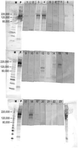 Figure 2. Western blot of anti-PLA2R in the serum of patients with primary MN. By western blot, anti-PLA2R antibodies were detected in 12 out of 23 (52%) patients with primary MN. ‘M’s represent protein molecular weight markers. ‘P’s represent positive controls (i.e., rabbit polyclonal antibodies against human PLA2R).