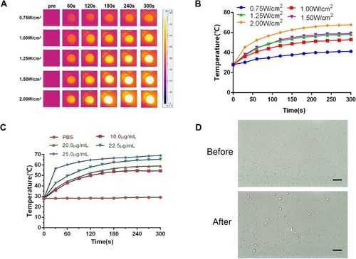 Figure 4 In vitro photothermal evaluation. (A) The picture of temperature evolution of CL-ICG-PFH-NPs under different power density laser. (B) Temperature evolution curves over time corresponding to different power density laser (n=3). (C) Temperature evolution curves over time corresponding to different concentration CL-ICG-PFH-NPs (n=3). (D) Optical microscope image of CL-ICG-PFH-NPs before and after laser irradiation (400 × magnification). After irradiation, the nanoparticles became larger and fused into microbubbles, the scale bar is 10 µm.Abbreviations: ICG, indocyanine green; PFH, perfluorohexanes.