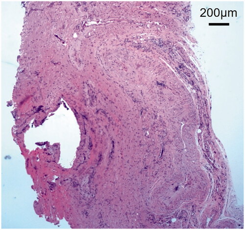 Figure 3. Histopathological view of granulation tissue: Inflammatory cell infiltration was observed. Scale bar 200 µm.