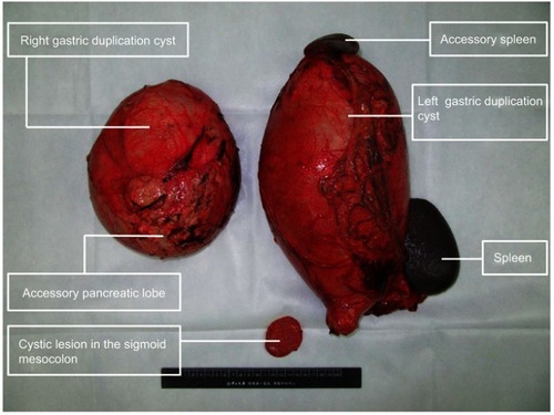Figure 4 Two duplication cysts and the cystic lesion in the sigmoid mesocolon.
