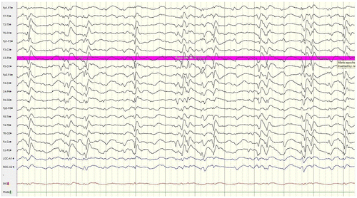 Figure 2. Burst and suppression in an initial EEG.