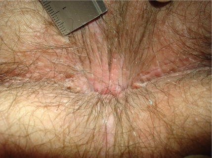 Figure 4a This 32-year-old man is in knee–chest position with his head left. He complained of anal itch at times combined with anal bleeding and pain. We see an inconspicuous anal verge covered with hairs.